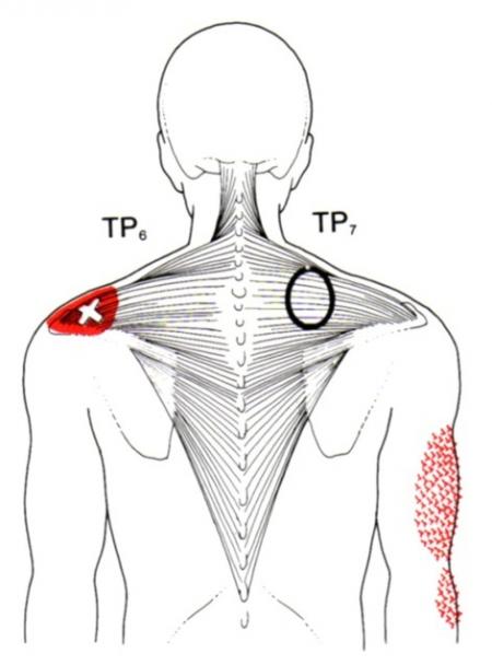 trapezius-the-trigger-point-referred-pain-guide